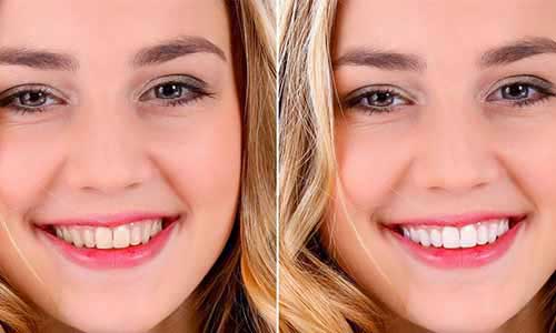 Limpieza Dental en La Serena